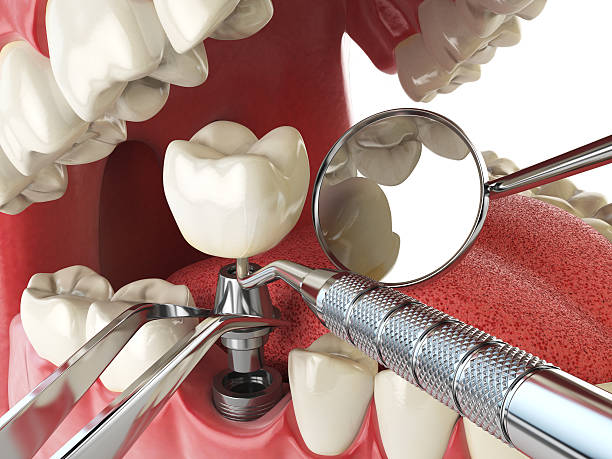 Best Emergency Root Canal Treatment in Eastwood, LA